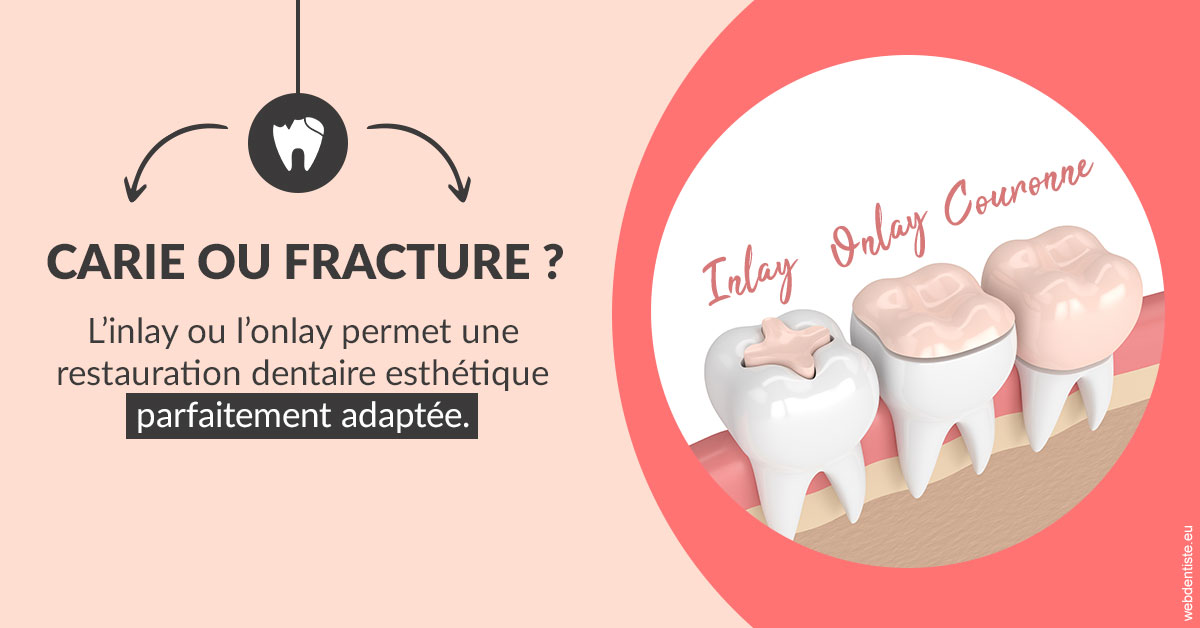 https://www.latelier-dentaire.fr/T2 2023 - Carie ou fracture 2