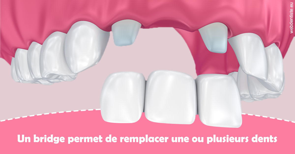 https://www.latelier-dentaire.fr/Bridge remplacer dents 2