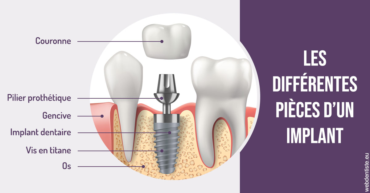 https://www.latelier-dentaire.fr/Les différentes pièces d’un implant 2