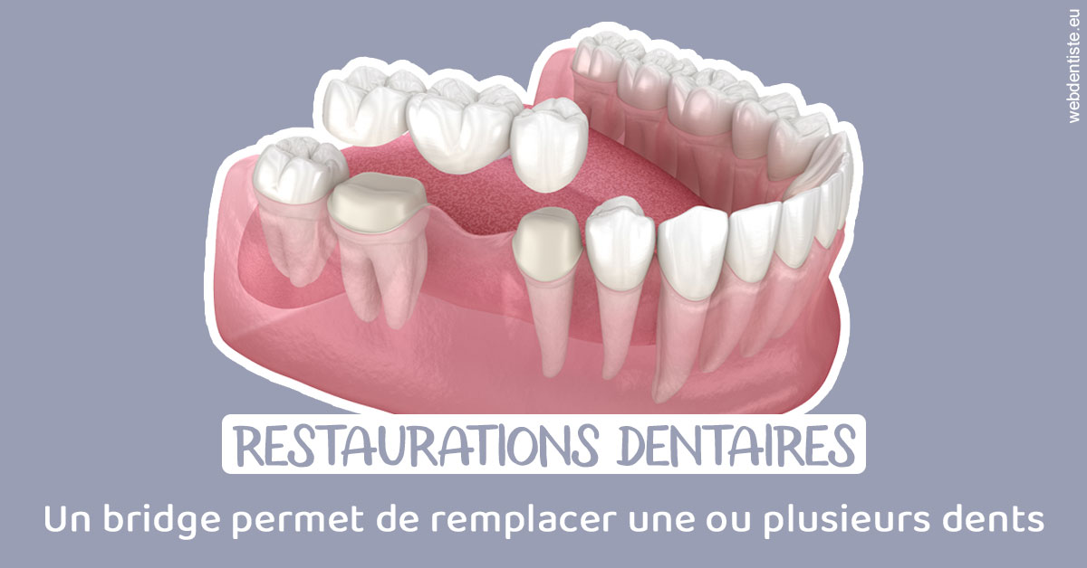 https://www.latelier-dentaire.fr/Bridge remplacer dents 1